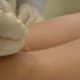 what-is-molluscum-contagiosum-and-how-to-treat-it