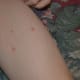 what-is-molluscum-contagiosum-and-how-to-treat-it