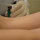 The dermatologist begins applying blister beetle juice to the molluscum contagiosum lesions.