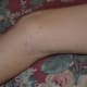 what-is-molluscum-contagiosum-and-how-to-treat-it