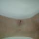 9/1/2012. Notice the healthy, white tissue beginning to appear around the edges.