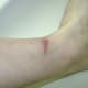 10/17/2012. New tissue developed, and the outer layer of my skin was restored.