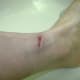 9/5/2012. More healthy tissue, and my nerve endings were becoming activated.