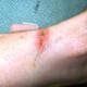 The progress of my infected cut. This was taken about 3 weeks after the cut.