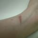 3/17/2013. Six months later, all that was left was a scar.