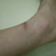 9/15/2012. I had very little pain, but the area was still sensitive.