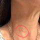 2 years post-procedure