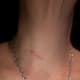 My scar four months post-op