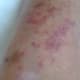 Throughout my life, I have had many problems because I bled a lot. If I cut myself, it would take a long time to stop the bleeding. My legs, arms and stomach were full of bruises even though I knew I had not injured myself.