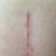 Hip replacement incision scar at 10 weeks