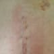 8-inch incision scar at 2 weeks (note bruising and swelling)
