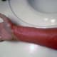Topical Steroid Withdrawal/Red Burning Arms and Hands