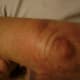 "Elephant Skin" Recovery Process