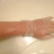 Severe Cracking Required Vinyl Gloves for 2 Years