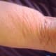 Steroid Inserts List "Thinning of Skin" as a "Side-Effect