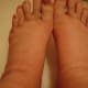 Swollen Feet in Recovery