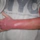Red Burn & Edema