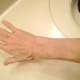 Healed Areas After 27 Months
