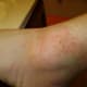 Rashy Areas all Over My Body
