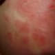 Severe Rash and Oozing Thighs