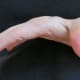 More Hypermobile joints in my hand