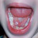 At two weeks, the hole for the wiggly incisor is completely healed, and the spaces where the canines had been are almost completely healed.