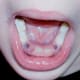 Forty-eight hours after the tooth extraction, the holes are starting to heal. The hole for the incisor is almost gone, since that tooth had been wiggly (it's root was partially dissolved already).