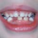 View of smile at two weeks after extraction. The adult central incisors are still out of place, but now there is space to begin moving them.