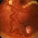 A VHL tumor of the eye