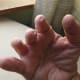 Tiny nails on tips of fingers affected by symbrachydactyly