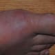 Most of the swelling and soreness was directly below the big toe. The left side of the big toe was also extremely sensitive.