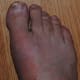 what-to-expect-the-first-time-you-have-gout