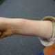 Once the test is complete, the patient's arm may be red. The redness will dissipate over the course of the day.