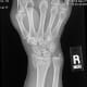 My broken wrist.