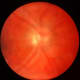 Although this isn't my retinal scan, it shows what vitreous floaters look like.