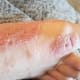 My foot during one of the bad times. All of the little bumps on the top of my foot were the beginnings of more sore patches.
