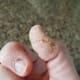 Sore thumb and finger, making holding a pen was impossible.