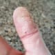 My thumb at one of its worst times.
