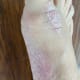 My foot today. It's not completely healed, but it is a big improvement I can live with.