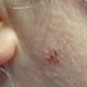 Mar 18, 2015. Wart free!