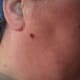 Mar 11, 2015. Wart has hardened, like a scab, and is smaller.