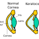 Keratoconus