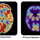new-level-of-coma-after-flat-line-neurophysiologists-discover-brain-re-ignition