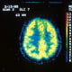 Position emission tomography (PET) of cerebral glucose utilization in a normal individual. The gray matter appears yellow-red and the white matter is green-blue and uses less glucose.