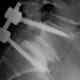 is-back-surgery-necessary