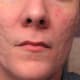 A man over the age of 40 with deep acne scars.