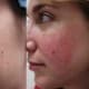 A woman in her mid-20s with acne scars on her cheeks.