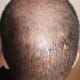 Vertex and Donor region. The redness has totally gone.