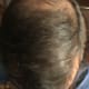 My Frontal and Temporal prior to HT