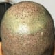 This is how the back of the head will look once the plaster is removed. As you can see it looks reddish in appearance and should look better as the days progress